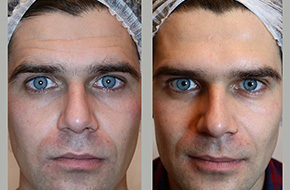 Botox, upper third
