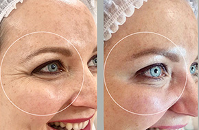 Botox