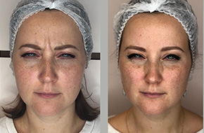 Botox