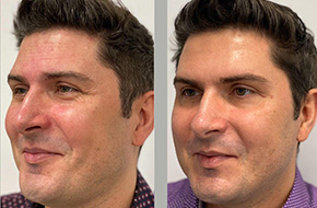 Botox