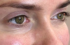 Botox