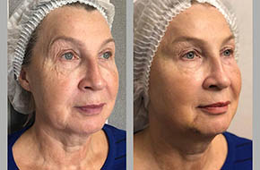 facial contouring