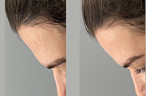 Facial contouring