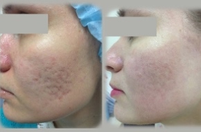 Treatment of acne scars and skin damage