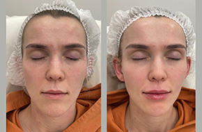 Lip filler