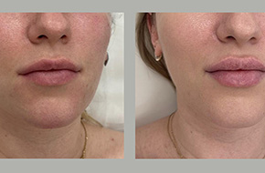 Lip filler