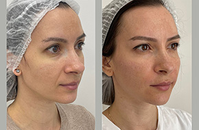Nasolabial folds contouring