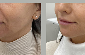 Facial contouring