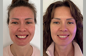 Botox + meso