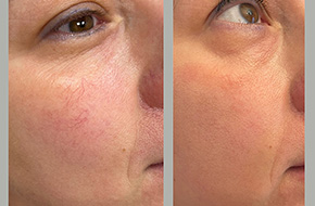 IPL: removal of broken capillaries