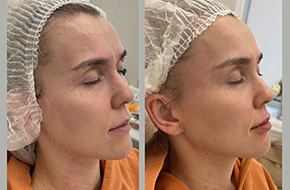 Non surgical temporal/lateral brow lift