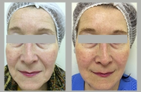 Contouring & volumisation of nasolabial folds